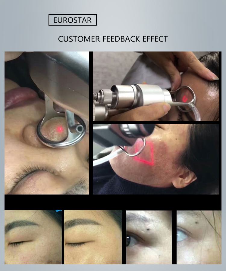 Lorance Co2 fractional laser for vaginal tightening, acne removal, skin rejuvenation and scar removal插图10