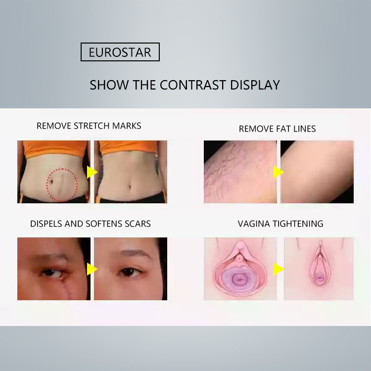 Lorance Co2 fractional laser for vaginal tightening, acne removal, skin rejuvenation and scar removal插图8