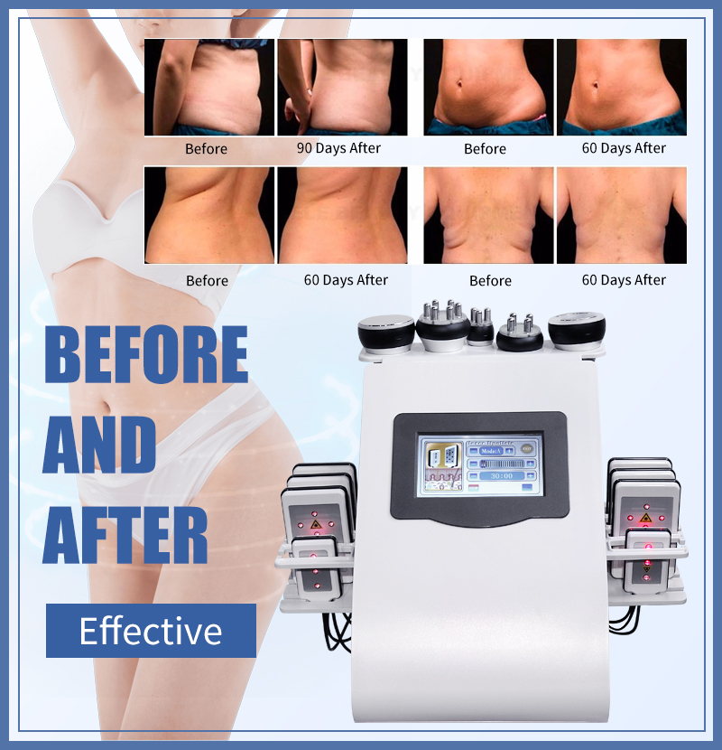 40K slimming machine with supersonic, cavitation, face & body RF and lipo laser.插图4