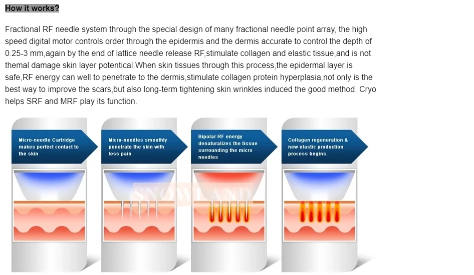 Professional Rf Microneedle Machine Fractional Microneedle Machine Skin Rejuvenation Remove Freckle Good Price插图